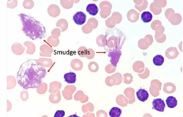 AliAl_khalifah's tweet image. سؤال طبي ⁉️

Elderly with lymphocytosis; smear shows smudge cells Diagnosis?

A) ALL

B) CML

C) CLL

D) Hairy cell leukemia

#hematology 
#laboratory 
#تحليل #مختبرات_طبية 
#AliAl_khalifah