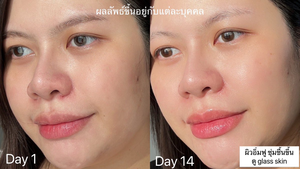 นอกจากหัตถการยกหน้าทุก 6 เดือน Eucerin Epicelline Serum นี่แหละคือตัวช่วยกู้ผิว สำหรับสาววัย 35 แบบแนน หน้าอิ่มฟู นุ่มเด้ง ชุ่มชื้นนาน ไม่แห้งกร้านต้นเหตุของริ้วรอยแรกเริ่ม

เซรั่มลดริ้วรอยตัวนี้แบรนด์คิดค้นมาจากศาสตร์ของ Epigenetics