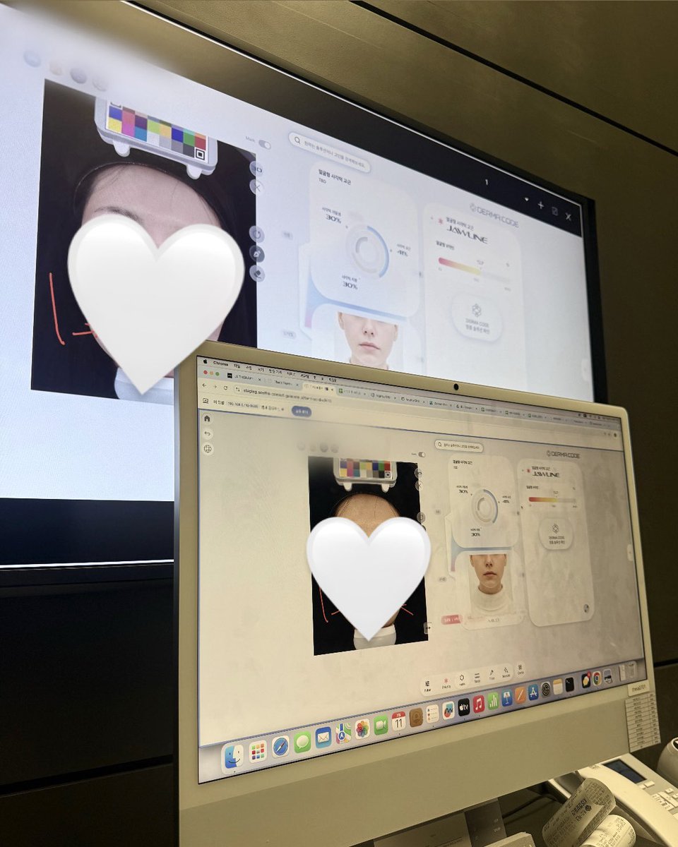 ddana_yooon's tweet photo. TheiAクリニックでチタニウムリフト受けてきた！AIが肌の状態とか必要な施術教えてくれて初心者にもオススメ💖
施術の部屋は完全個室で静かでよかった🙆🏻‍♀️施術は結構痛かったけどイケメンで優しい先生で耐えられました😻笑
直後から顔が一回りちっちゃくなってて最高！リピあり◎ https://t.co/PZ6hxtr3eD