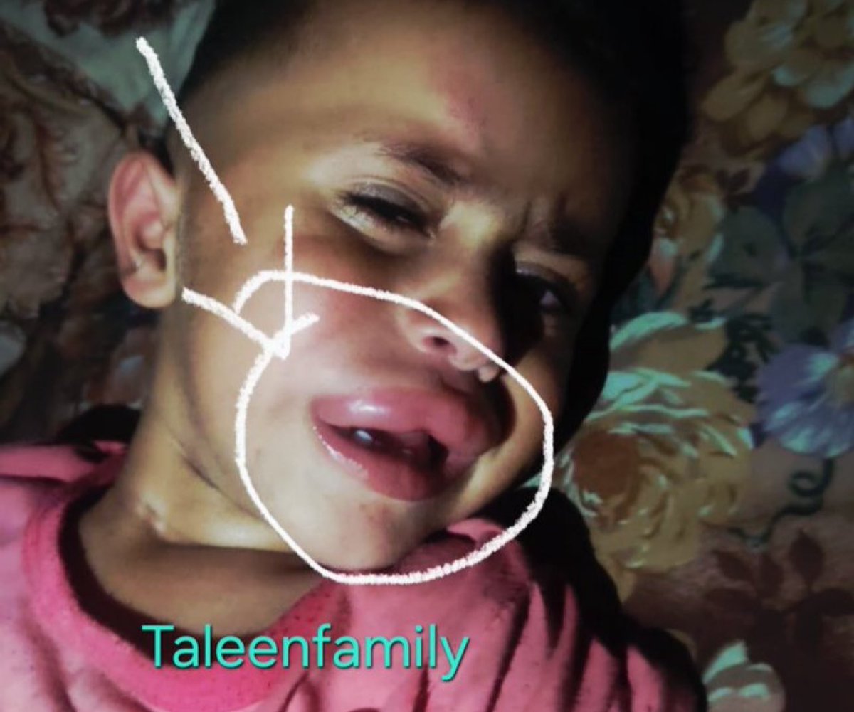 TaleenFamily's tweet photo. My little son suffers from crazy pain, he suffers from a "Rat bite" due to lack of shelter and cleanliness, we sit in a shelter full of flies, insects and garbage, our house is completely destroyed

3 replies - even dots — can save my children

https://t.co/Uwi0wORDIb https://t.co/tmcLF7HURV