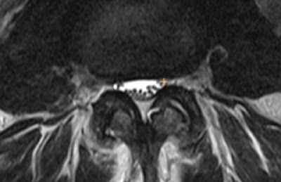 Radiology_AI's tweet photo. The LumbarDISC dataset: multisequence, multiplanar adult MRI lumbar spine data from 8 institutions, with image level annotations https://t.co/gmUtuGmDhF  #DataResources #MedicalImaging #ML https://t.co/y7yzJ9xGHF