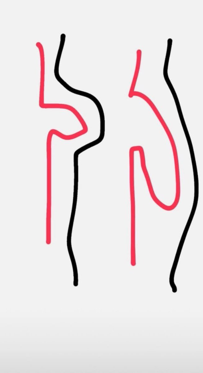 touchmm12369's tweet photo. 在推上看到這個，誰來告訴我這個是真的嗎？

记住一个口诀
「顺则长，短则凸」 https://t.co/HmoxDVDRLe