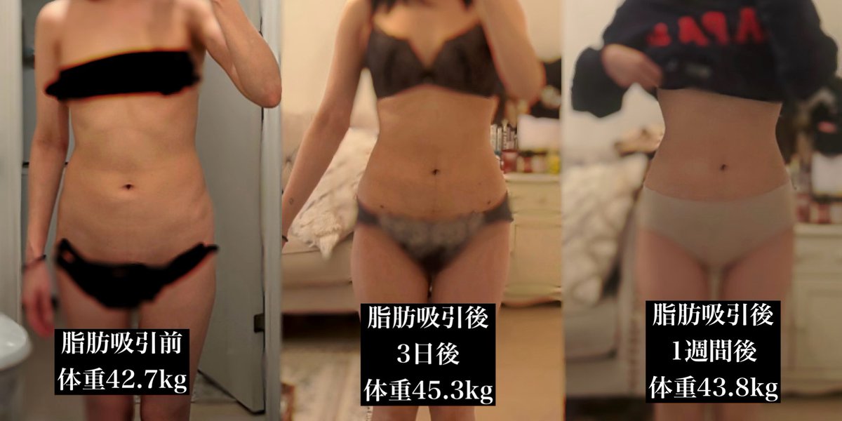 🏥狎鴎亭TOP LINE
📝お腹とラブハンドル脂肪吸引経過
手術日2026/3/9
術後翌日からあざもなく綺麗な状態でした🥺
一週間経った本日、浮腫もかなり軽減しており
くびれができたことが本当に嬉しいです🥺❤️
@aptopline1675 https://t.co/oitjykb1mF