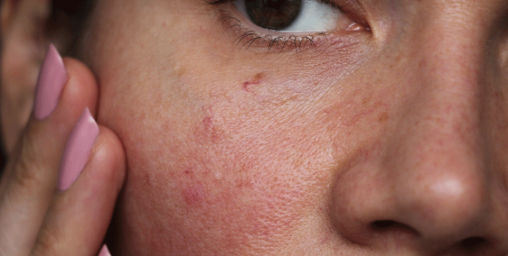 WellnessTribeOn's tweet photo. Got sensitive skin? It's prone to redness, itching &amp; irritation, often due to a weak skin barrier or conditions like eczema, rosacea, acne. Use fragrance-free products, patch test new stuff, and choose thick moisturizers with soothing ingredients like oats or shea butter. #Skin https://t.co/TcylxLDJuZ