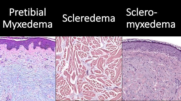 JMGardnerMD's tweet photo. Pretibial Myxedema vs Scleredema vs Scleromyxedema. 
#Dermpath "Sound-a-likes" (not Look-a-likes). 
Labeled infographic to easily tell them apart: https://t.co/MovT543zYG. 
Video: https://t.co/8jA9Hjc3dJ 
#pathology #pathologists #pathTwitter #dermatology #dermatologia https://t.co/JZQtOoZkcj