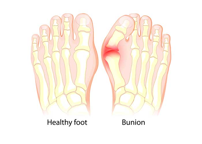 sportsfootankle's tweet image. Bunions aren’t just “knobs on the foot.”
Diagnosis starts with questions + a thorough physical exam. Weight-bearing X-rays reveal the foot’s structure and guide treatment. Advanced imaging like MRI or CT is rarely needed. medilink.us/t2b9 #FootHealth