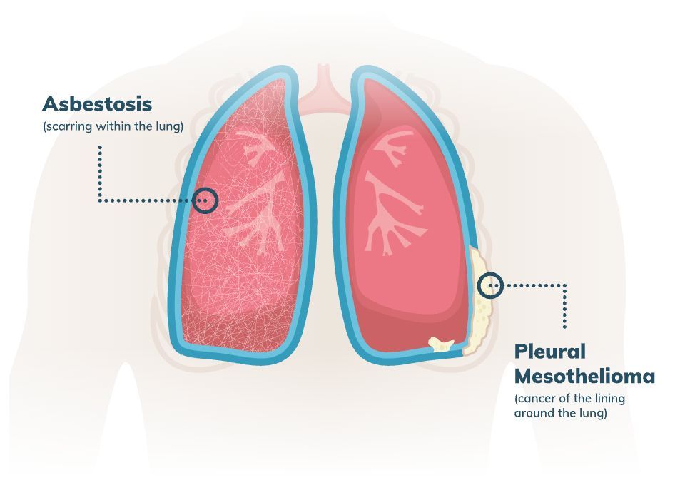 Mesothelioma.com tweet media