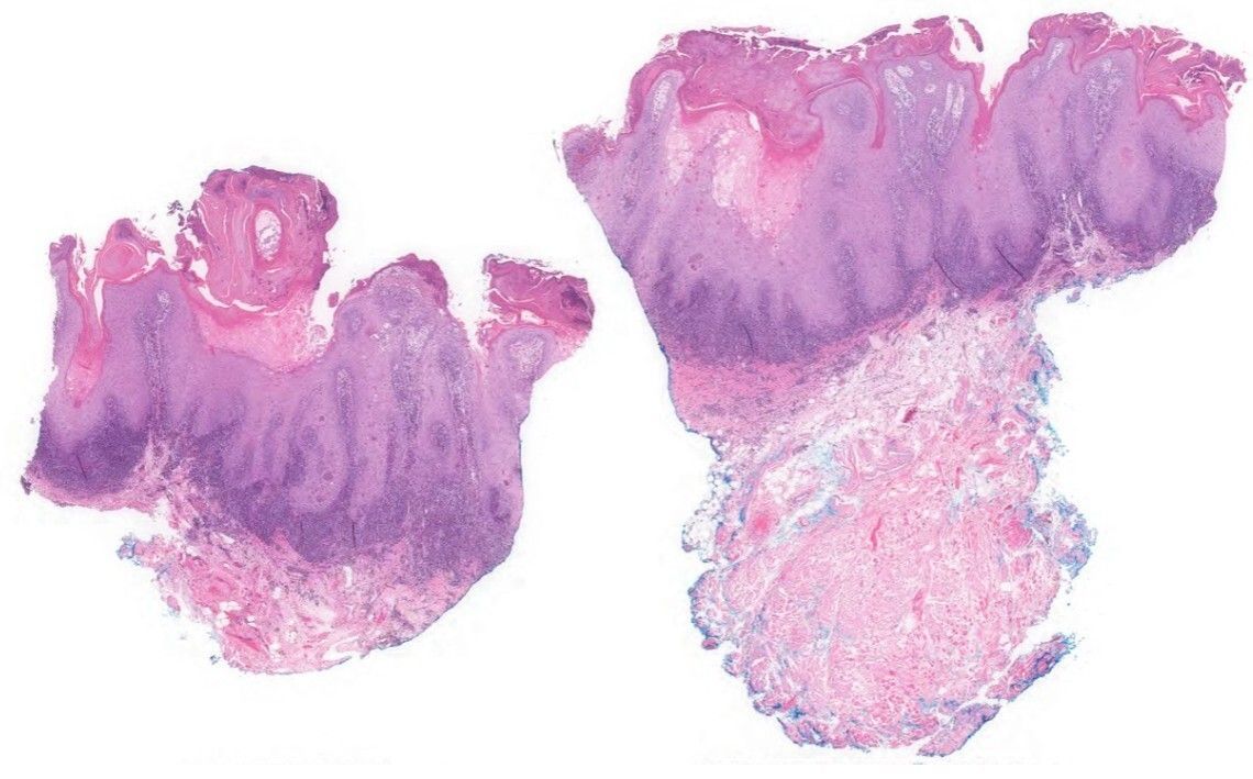 American Society of Dermatopathology tweet media