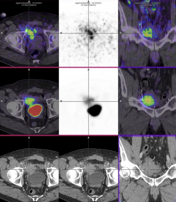 urotoday's tweet photo. #ZipUP: 89Zirconium-labelled girentuximab PET in patients with #UrothelialCancer - a phase 1 study of a novel staging modality for #UrothelialCarcinoma. Presented by Dickon Hayne, MD, FRCS @uwanews. #EAU26 written coverage by @zklaassen_md @GACancerCenter > https://t.co/wmTguA8myd @Uroweb