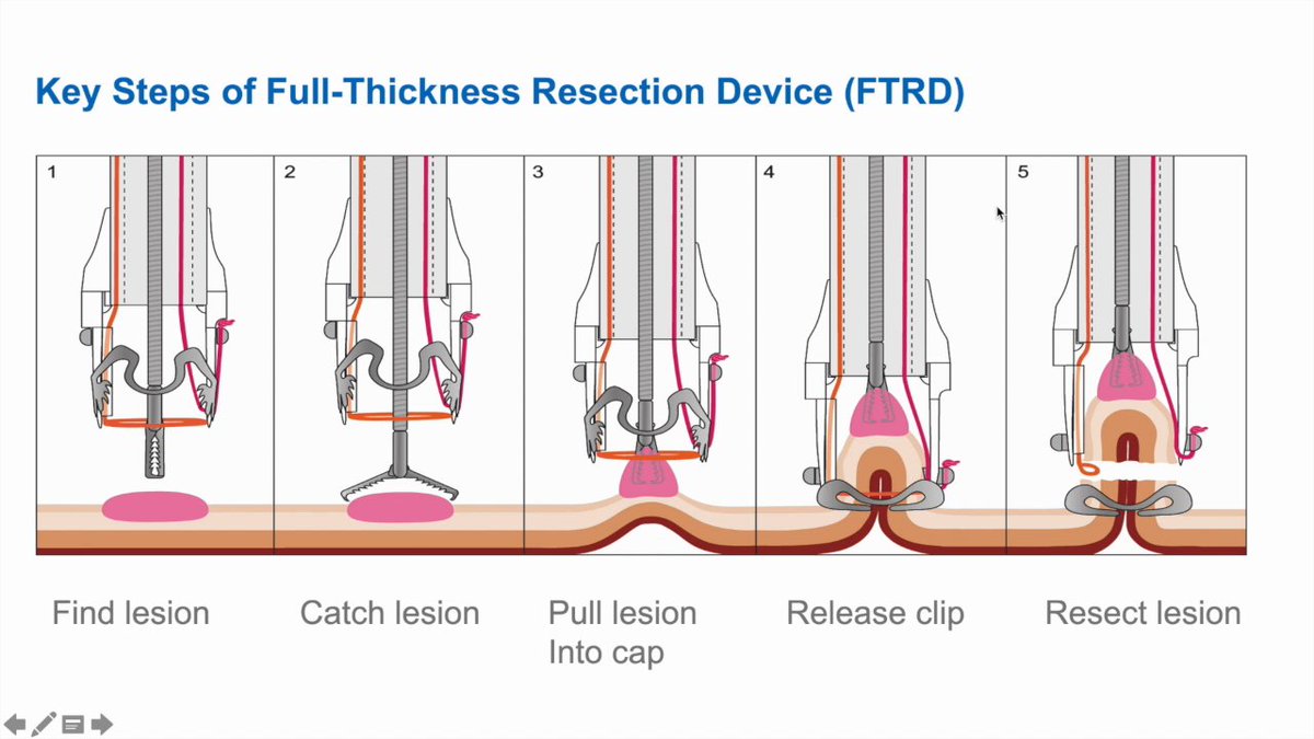 EndoCollab™ | GI Endoscopy Community tweet media