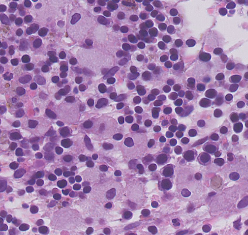 Tiger_heme's tweet photo. BMB, a child with beta thalassemia. What are these cells? https://t.co/veBwLWJTXs