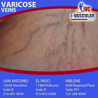 Ivascularcenter's tweet photo. VARICOSE VEINS tend to occur in people 30-70 years old. Just over 50% of pregnant women develop varicose veins. While most of these women will see their veins return to normal within a year, women with multiple pregnancies may have them permanently. More: https://t.co/W80MZ0U1Lv https://t.co/8q2lyIz5Yb