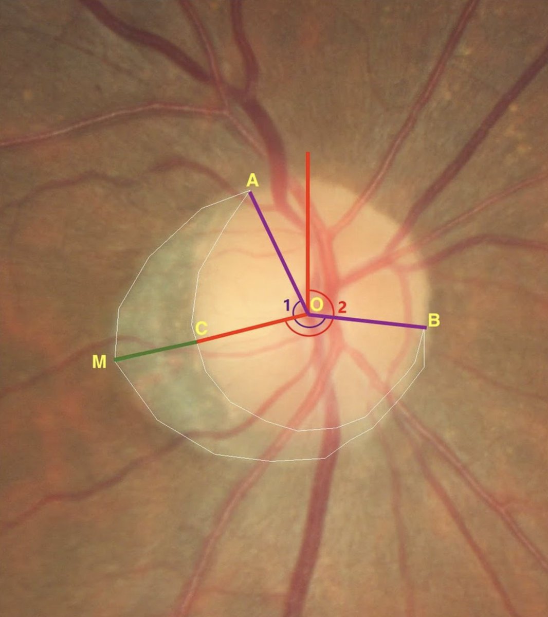 revoptom's tweet image. Microvascular Dropout, Beta-zone PPA Enlargement Predict Optic Disc Structural Progression in Glaucoma Suspects

Patients with both markers are at highest risk, study finds.
reviewofoptometry.com/article/microv…
#glaucoma #optometry