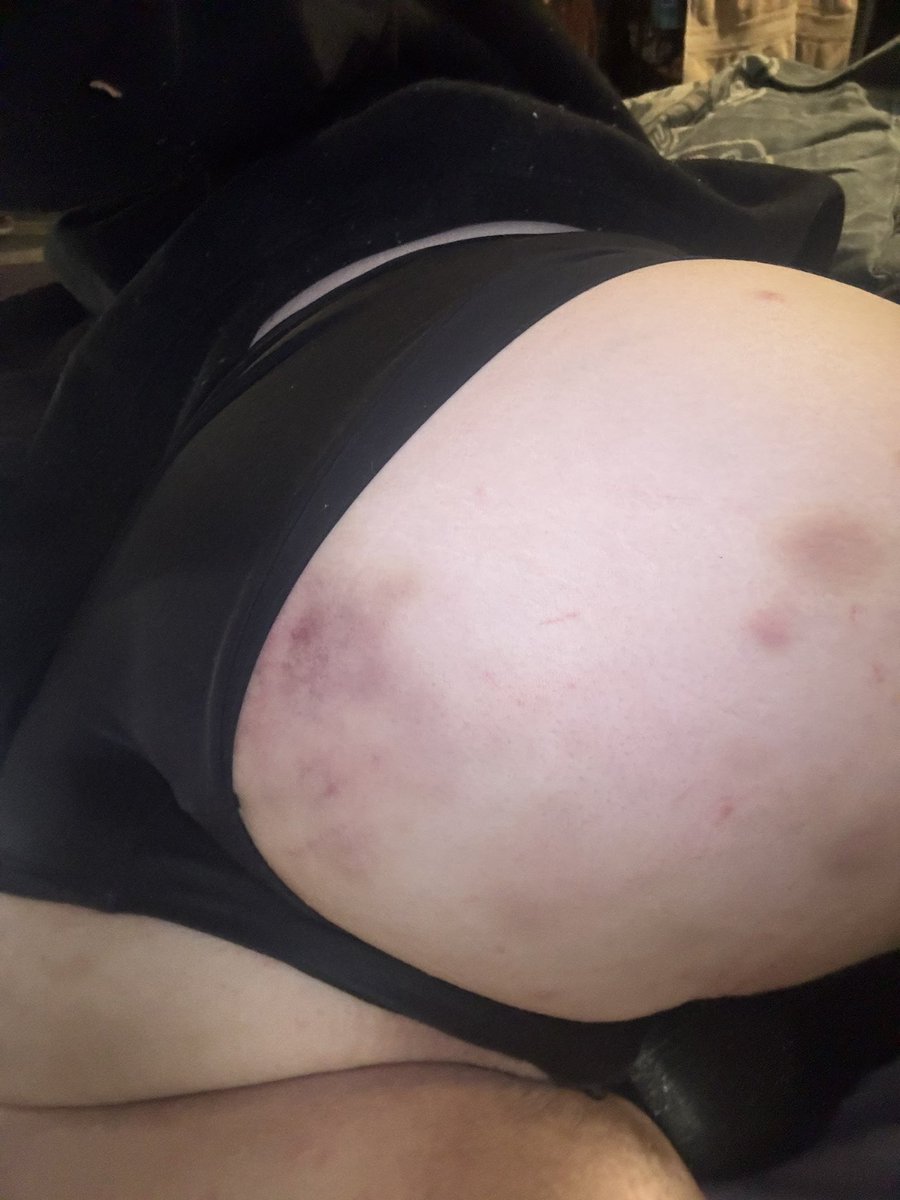 RandMllz's tweet photo. daddy gave me bruises to remind me who i belong to..

#inpactplay #spanking #cnc #punishment #freeuse #chudai #roughsex https://t.co/a4ag4glHSC