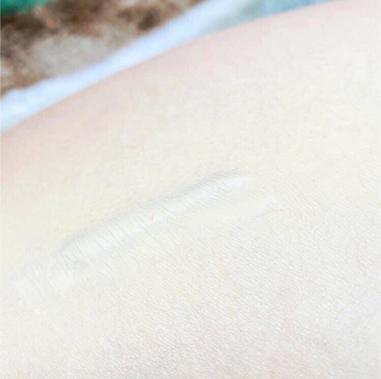bodyconcealer's tweet photo. 傷跡隠しに！ミミズ腫れになって残ってる傷跡も赤みをカバーするだけで周囲の視線が気にならなくなります🌿これはアップで写してる写真なので遠目から見たら、ほとんど分かりません⭕️傷跡や肌にコンプレックスがあるから..と諦めないで下さい✨️#tattoo #刺青 #傷跡 #手術跡 #肌 #サウナ #銭湯 https://t.co/A3hebvvVFT