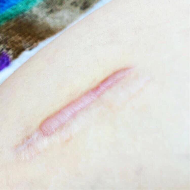 bodyconcealer's tweet photo. 傷跡隠しに！ミミズ腫れになって残ってる傷跡も赤みをカバーするだけで周囲の視線が気にならなくなります🌿これはアップで写してる写真なので遠目から見たら、ほとんど分かりません⭕️傷跡や肌にコンプレックスがあるから..と諦めないで下さい✨️#tattoo #刺青 #傷跡 #手術跡 #肌 #サウナ #銭湯 https://t.co/A3hebvvVFT