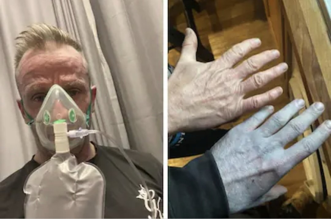 ciencia1M's tweet photo. Hablemos de gente azul: Un hombre va a urgencias porque despertó azul, le ponen oxígeno porque cuando alguien tiene el nivel de oxígeno bajo o la circulación no funciona bien,la piel puede verse azul. Descubrieron que el día anterior durmió en sábanas nuevas y no las había lavado https://t.co/a1BgfNePao