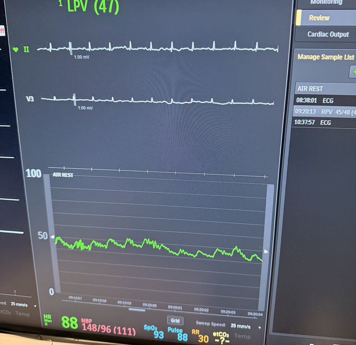 DrJayMohan's tweet image. I honestly thought I was arterial on this DVT case

Arterialized vein. Proximal obstruction. IVC fibrosis (hx of IVC filter with removal). 

Venoplasty. Will bring back for IVC iliac recon with Z stent and prob double barrel vena. Would be a great Fortegra case! 

#DVT #IVC