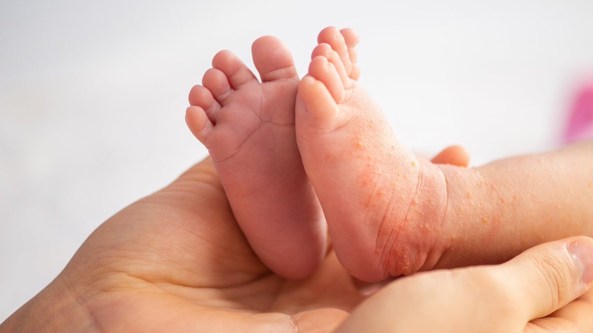 National Allergy Centre of Excellence tweet media