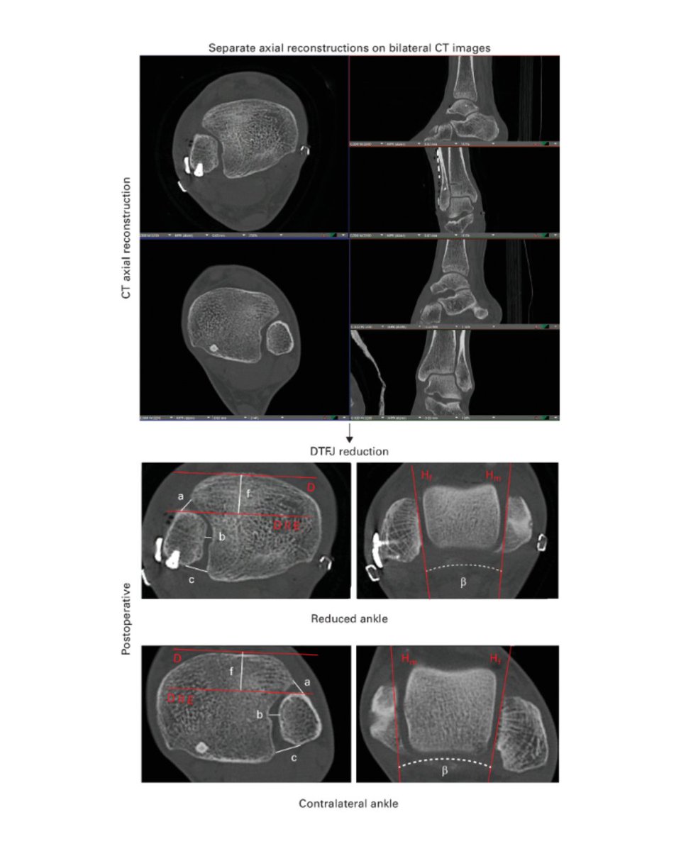 BoneJointJ's tweet image. Little is known about the distal tibiofibular joint malreduction rate following ventral anterior inferior tibiofibular ligament augmentation in two-ligament fracture cases.

#Ligament #Injury #Ankle #Orthopedics

ow.ly/Ocxf50Ytrnt