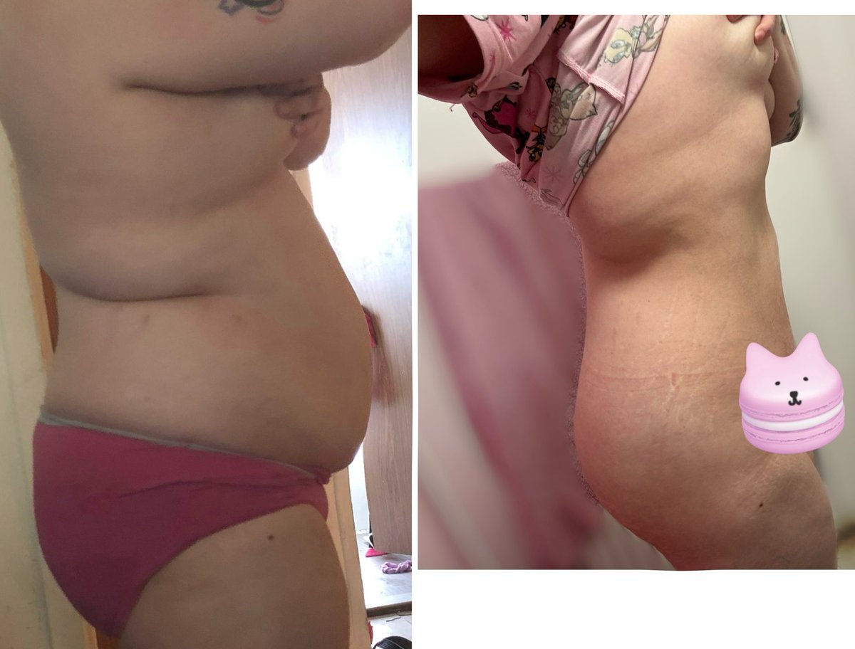 ToastyMosty6969's tweet image. 215lb (age 23 )vs now 135lb (age 33) on a 5 ft frame after 2 kids. 

No I wasn’t pregnant in my before photo.

#weightloss #weightlossjourney