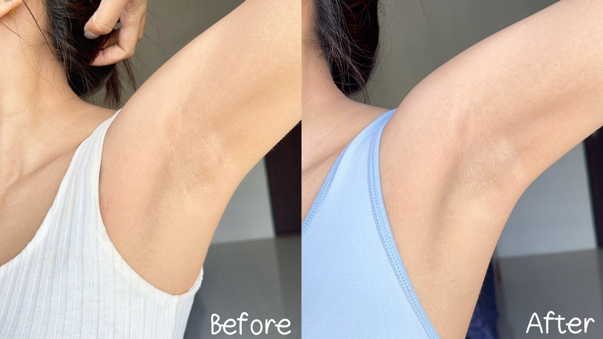 สมกับที่เป็นคลีนเซอร์ที่หมอผิวแนะนำอันดับ1 Cerave SA ตัวนี้ ปกติล้างหน้าก็ใช้ดีอยู่แล้ว ชีลดหนังไก่ได้โดยไม่ต้องขัด เวลาอาบน้ำก็แค่ฟอกทิ้งไว้ 2 นาที ไม่แสบ นี่ใช้ประจำช่วงหลังเลเซอร์ ไม่ใช่แค่อ่อนโยน แต่ช่วยให้ผิวแข็งแรง นุ่มขึ้นด้วย ขนคุดหายไปเลย หนังไก่แทบไม่มี ของดี!!

แอพส้ม