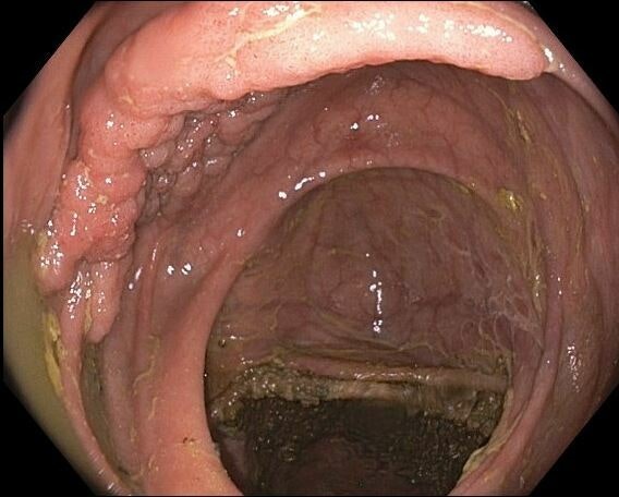 EndoCollab™ | GI Endoscopy Community tweet media