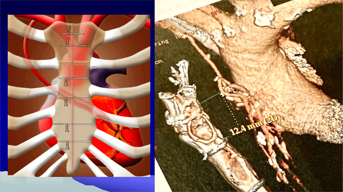 hsfeditor's tweet photo. 🫀The latest work from @UPMC_CTSurgery by first author Dr. Venkat R. Machiraju and his team is now featured in HSF!

Link👉:https://t.co/boiNGtuSk5

💡Can #TAVR #PercutaneousInterventions cut #RedoCardiacSurgery risks? #Cardiology #CardiacSurgery #HeartSurgery
#HeartHealth #Risk https://t.co/Qe11JlxhOR