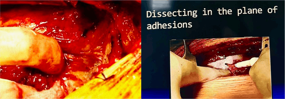 hsfeditor's tweet photo. 🫀The latest work from @UPMC_CTSurgery by first author Dr. Venkat R. Machiraju and his team is now featured in HSF!

Link👉:https://t.co/boiNGtuSk5

💡Can #TAVR #PercutaneousInterventions cut #RedoCardiacSurgery risks? #Cardiology #CardiacSurgery #HeartSurgery
#HeartHealth #Risk https://t.co/Qe11JlxhOR