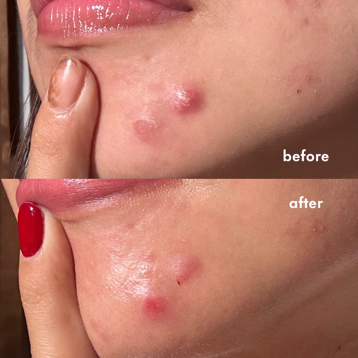 pokoknya kalau misal udah keliatan jerawat kaya gini, aku langsung pindah pakai produk skincare yang KHUSUS utk acne kaya acnes ini😩☝️

dari facial wash, sunscreen, sampai acne spotnya aku langsungin pake selama jerawatnya ada &amp; hasilnya keliatan bgt🥰