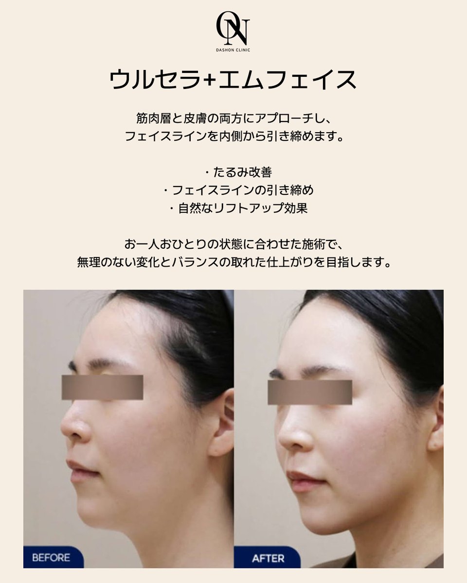 dashon_jpn's tweet photo. ダシオンクリニックのウルセラ＋エムフェイス。二重あごを改善し、フェイスラインを引き締めます。

ご予約やお問い合わせ、LINEからどうぞ！💖
 
#韓国美容 #ウルセラ #リフトアップ #小顔 #二重あご改善 👍 https://t.co/4TBmbQxyDr