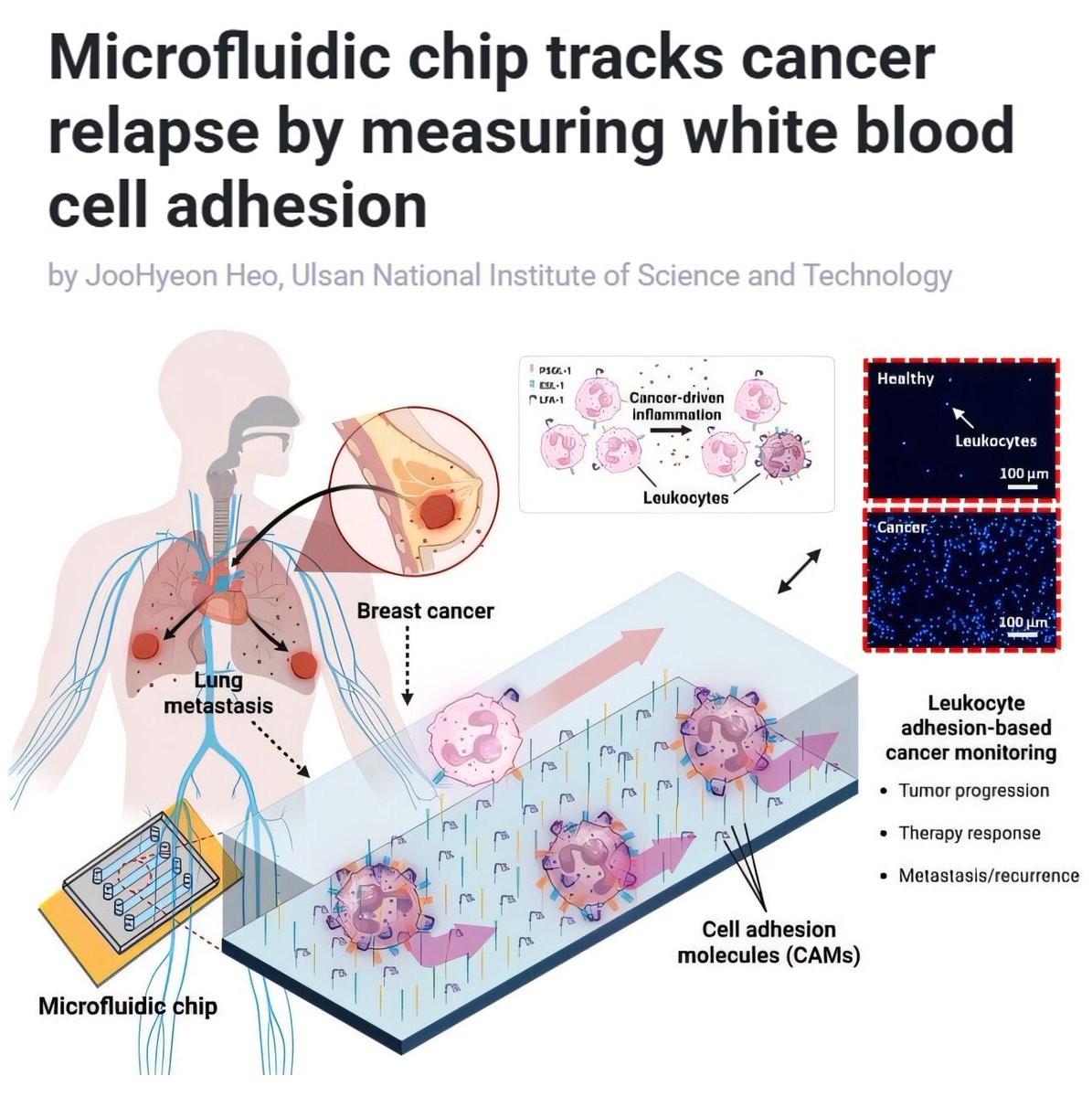 Vaccinologist's tweet image. Smart pivot: using #immunecell behavior instead of chasing #tumor cells. Leukocyte adhesion as a signal for relapse + #chemotherapy treatment response is a big step toward real-time #cancer monitoring. linkedin.com/posts/drmelvin…
