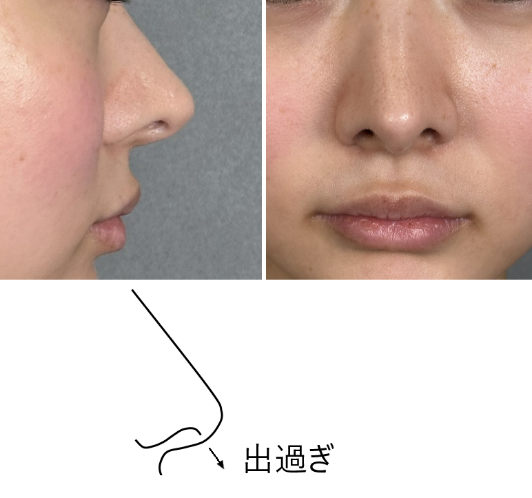 dr_sakano's tweet photo. 側面だと綺麗な四角鼻なのに正面だと矢印鼻。
原因は鼻柱。
四角鼻が良いからといって「”四角”にすること」にこだわり過ぎると過剰な突出につながります。
付け足すことだけで形を作ろうとすると綺麗な目立つ鼻になる可能性があります。 https://t.co/UvWwjp3zl4