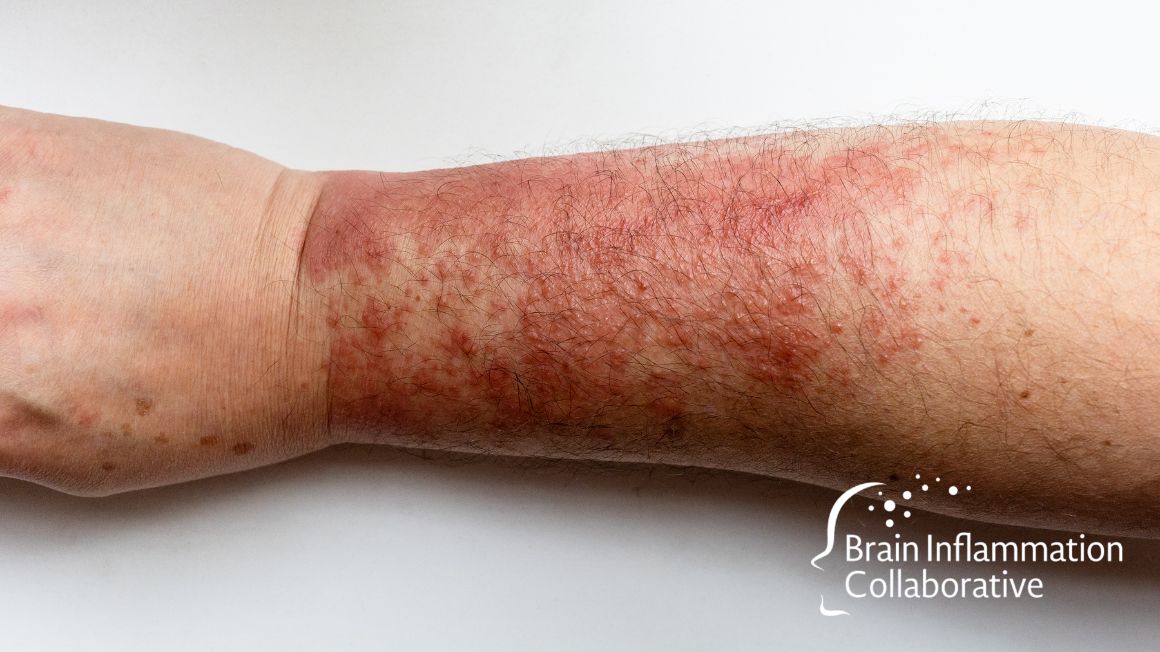 Brain Inflammation Collaborative tweet media