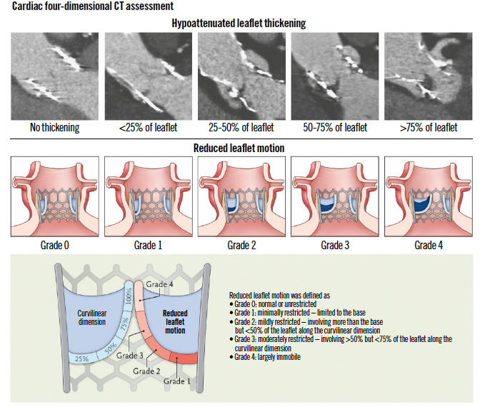 EuroIntervention tweet media