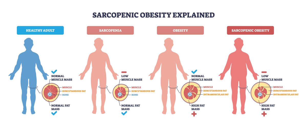 🧓🏽💪 Obesidad sarcopénica, en 3 claves:

• Fuerza + aeróbico: lo mejor para bajar grasa corporal
• Entrenamiento de fuerza: lo mejor para mejorar la fuerza de agarre
• Nutrición sola: sin beneficios claros 📊

link.springer.com/article/10.118…