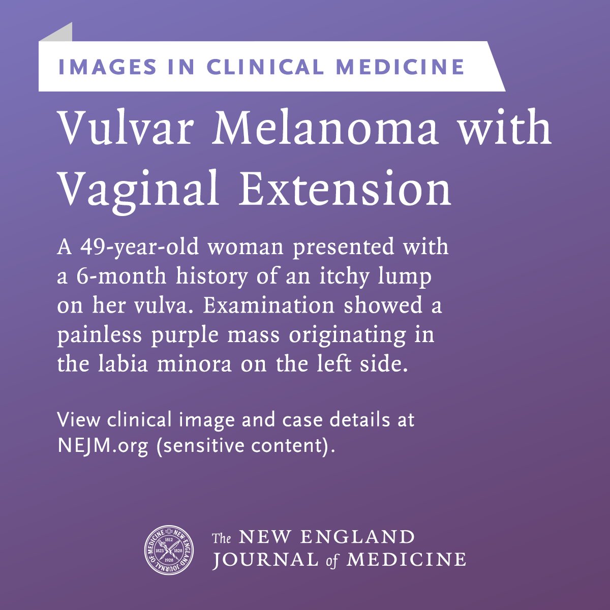 NEJM's tweet image. Images in Clinical Medicine: Vulvar Melanoma with Vaginal Extension nejm.org/doi/full/10.10… #Oncology #OBGYN
