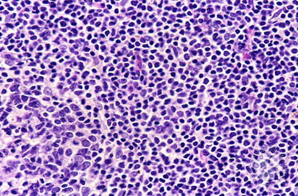 sanamloghavi's tweet image. Mantle cell lymphoma (MCL) shows monotonous lymphocytes &amp;amp; hyalinized vessels in lymph nodes. Key takeaway: Recognize these features, do a cyclin D1 IHC and clinch the diagnosis! 🔬
Credit: Marshall Kadin, ASH Image Bank. #MedEd #Hematology #ASHImageBank #hemepath