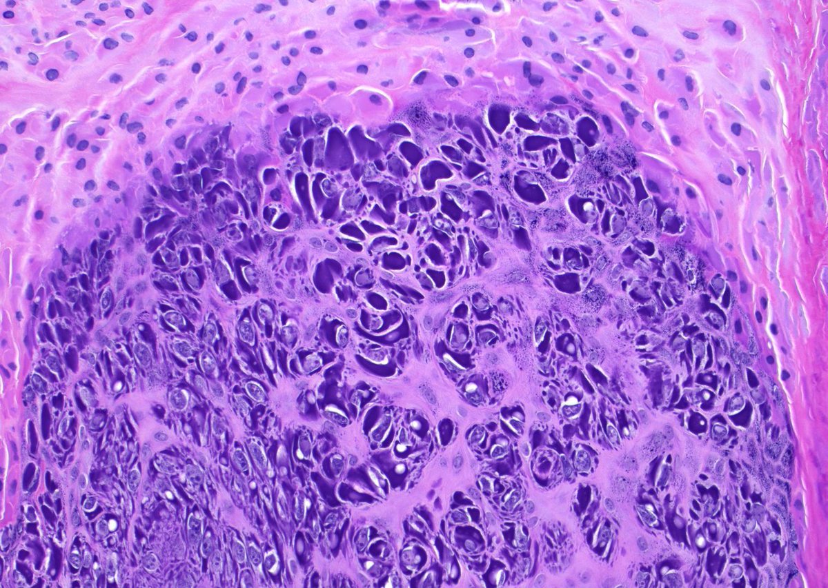 20 yo woman. Thumb lesion. A perfect example! Diagnosis? 
Answer ✅  youtu.be/G31xlSgYSlw?si… 
 #pathology #pathologists #pathTwitter #dermpath #dermatology #dermatologia #dermtwitter