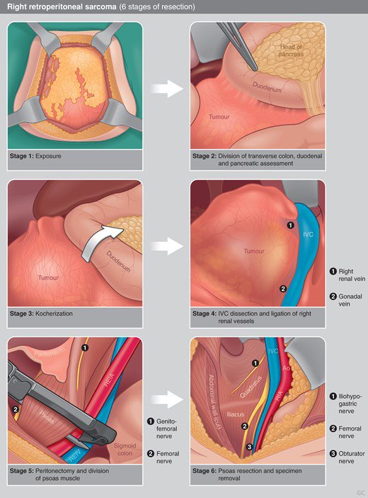 PipeCabreraV's tweet photo. The 6 stages of resection for retroperitoneal sarcomas 🔪⤵️💥! @SWexner @pferrada1 @BJSAcademy @BjsOpen @TomVargheseJr @juliomayol https://t.co/R7VbD4osWi