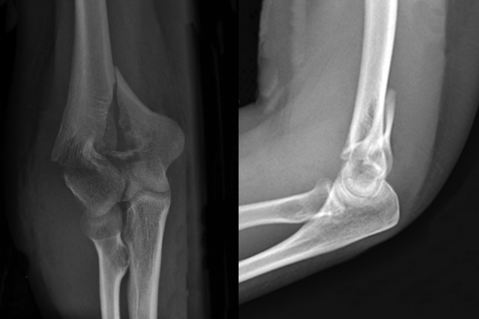 Unaffected Side The olecranon manubrium percussion test evaluates for fractures in the ...