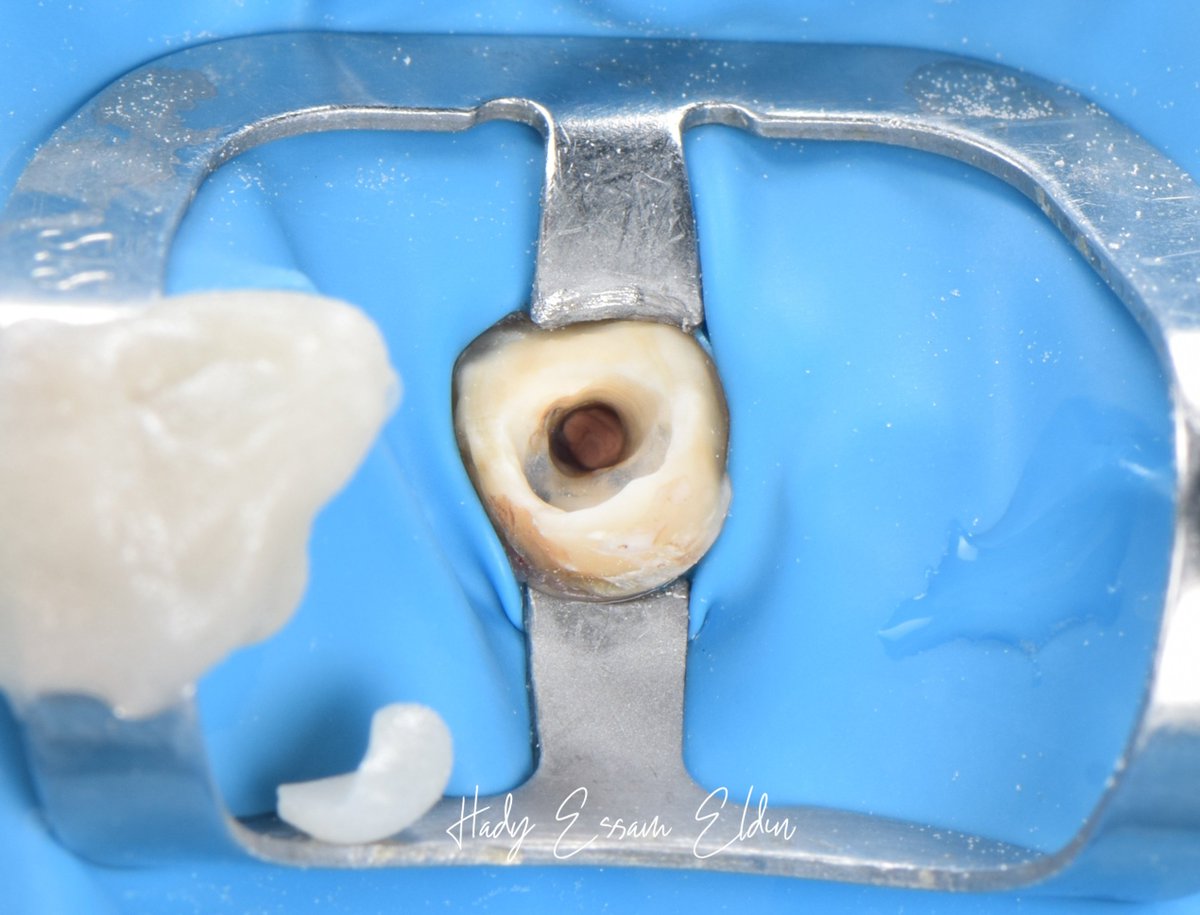 hadyessam10's tweet photo. تسمع عن الـ internal adhesive ferrule يا صاحبي؟

Full case
Insta: https://t.co/Vx8eH5TNnP
Fb: https://t.co/7F40CLGssf https://t.co/Ibj8WYdFBL