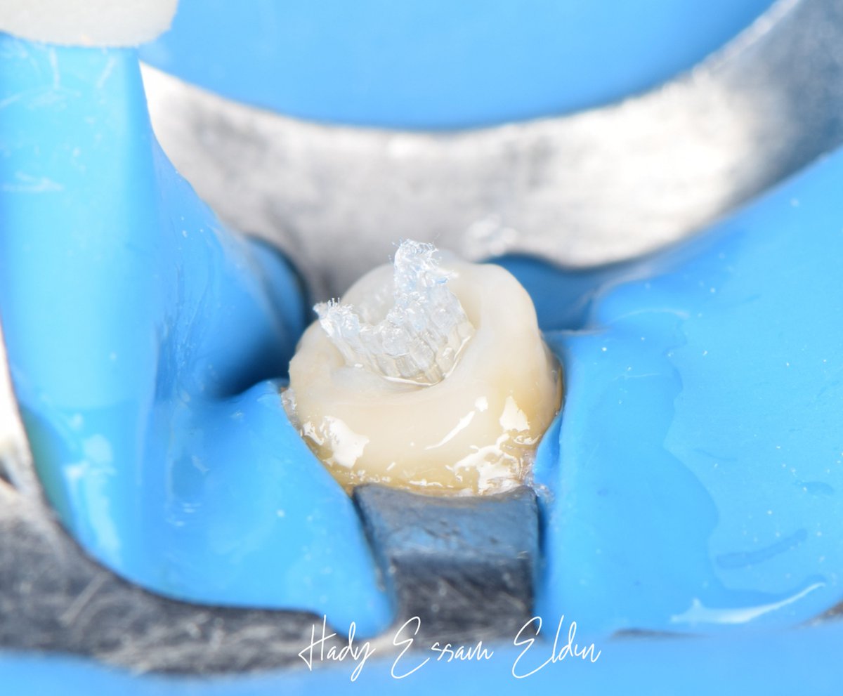 hadyessam10's tweet photo. تسمع عن الـ internal adhesive ferrule يا صاحبي؟

Full case
Insta: https://t.co/Vx8eH5TNnP
Fb: https://t.co/7F40CLGssf https://t.co/Ibj8WYdFBL