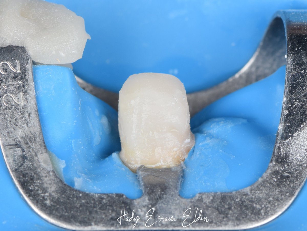 hadyessam10's tweet photo. تسمع عن الـ internal adhesive ferrule يا صاحبي؟

Full case
Insta: https://t.co/Vx8eH5TNnP
Fb: https://t.co/7F40CLGssf https://t.co/Ibj8WYdFBL