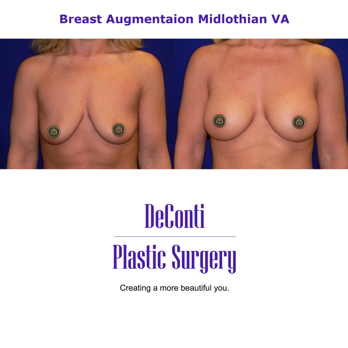 DeConti_MD's tweet photo. The "Empowerment"
From insecurity to confidence. 🦋

👉 Explore Your Before and After:
https://t.co/lM28kcQvey

We specialize in breast implants, breast lifts, and revision surgeries.

Schedule NOW! Before the summer is here!

☎️ 804 673-8000 https://t.co/fXidd8HagQ