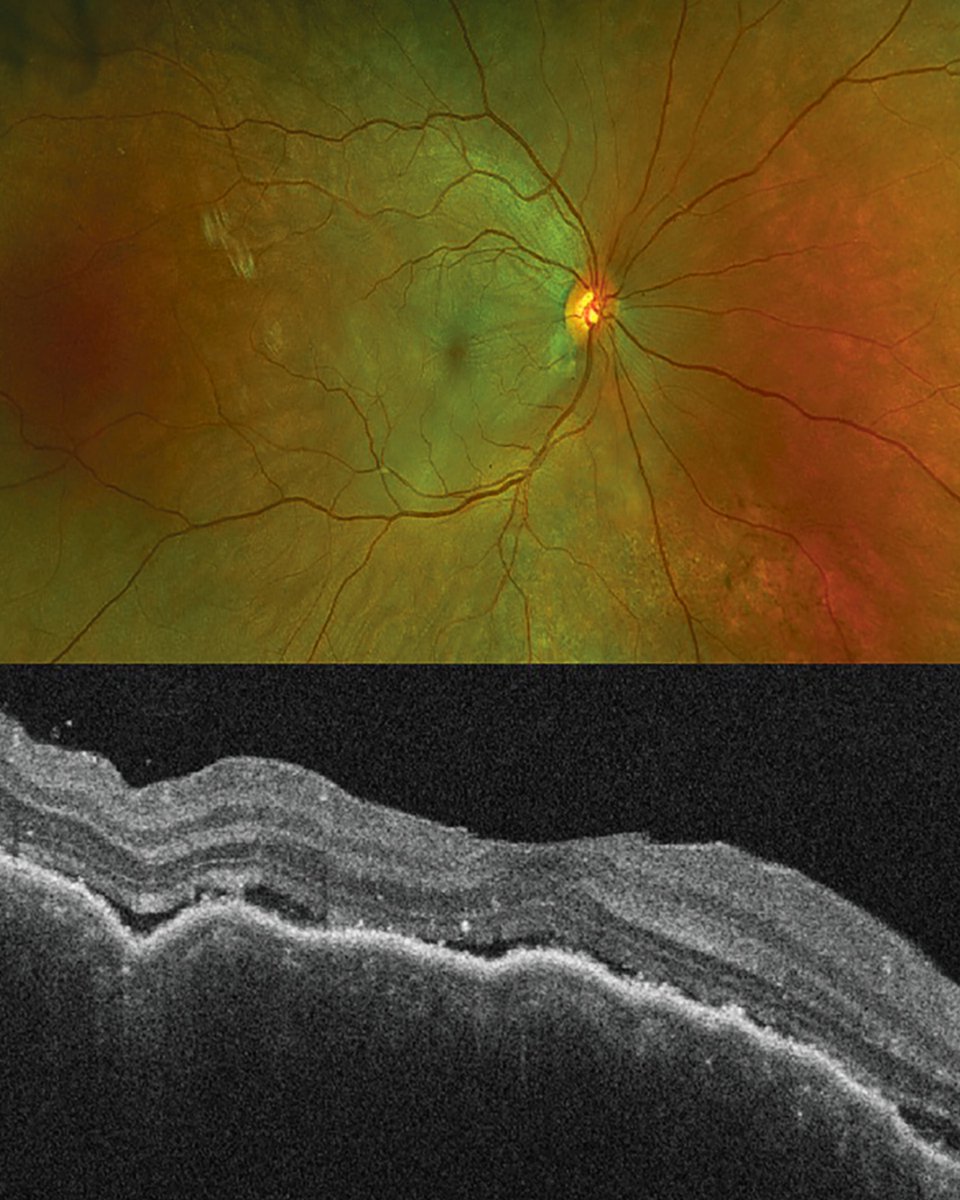 Retina Specialist tweet media