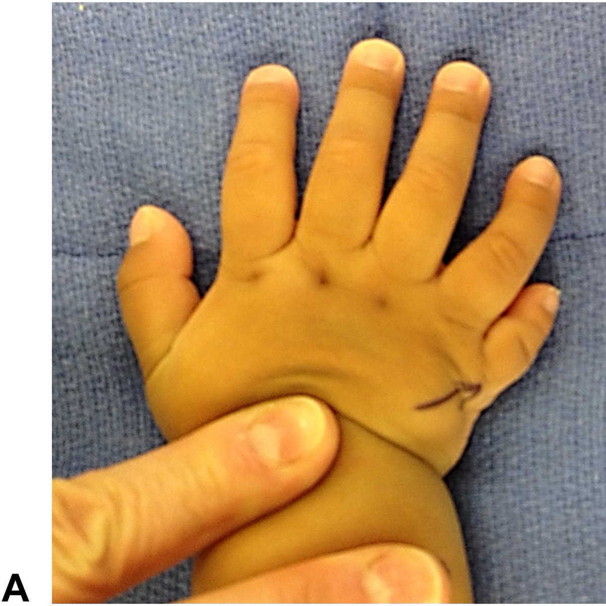 J Hand Surg Am- ASSH tweet media