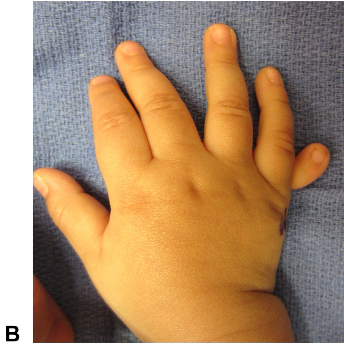 J Hand Surg Am- ASSH tweet media