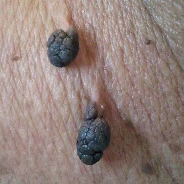YosuepEstebanX's tweet photo. La afección más peligrosa que los médicos nunca detectan:

Niveles altos de cortisol.

Provoca silenciosamente aumento de peso, desequilibrios hormonales y enfermedades cardíacas.

Aquí hay 8 maneras de solucionarlo como un médico:

1. Revisa si hay verrugas cutáneas. https://t.co/5ncQaPSBl1