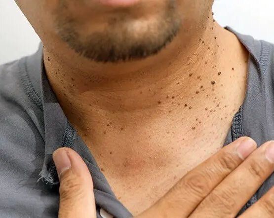 YosuepEstebanX's tweet photo. La afección más peligrosa que los médicos nunca detectan:

Niveles altos de cortisol.

Provoca silenciosamente aumento de peso, desequilibrios hormonales y enfermedades cardíacas.

Aquí hay 8 maneras de solucionarlo como un médico:

1. Revisa si hay verrugas cutáneas. https://t.co/5ncQaPSBl1